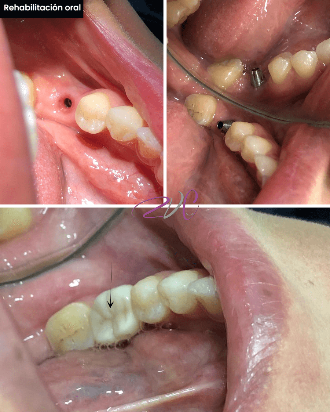 Rehabilitación oral