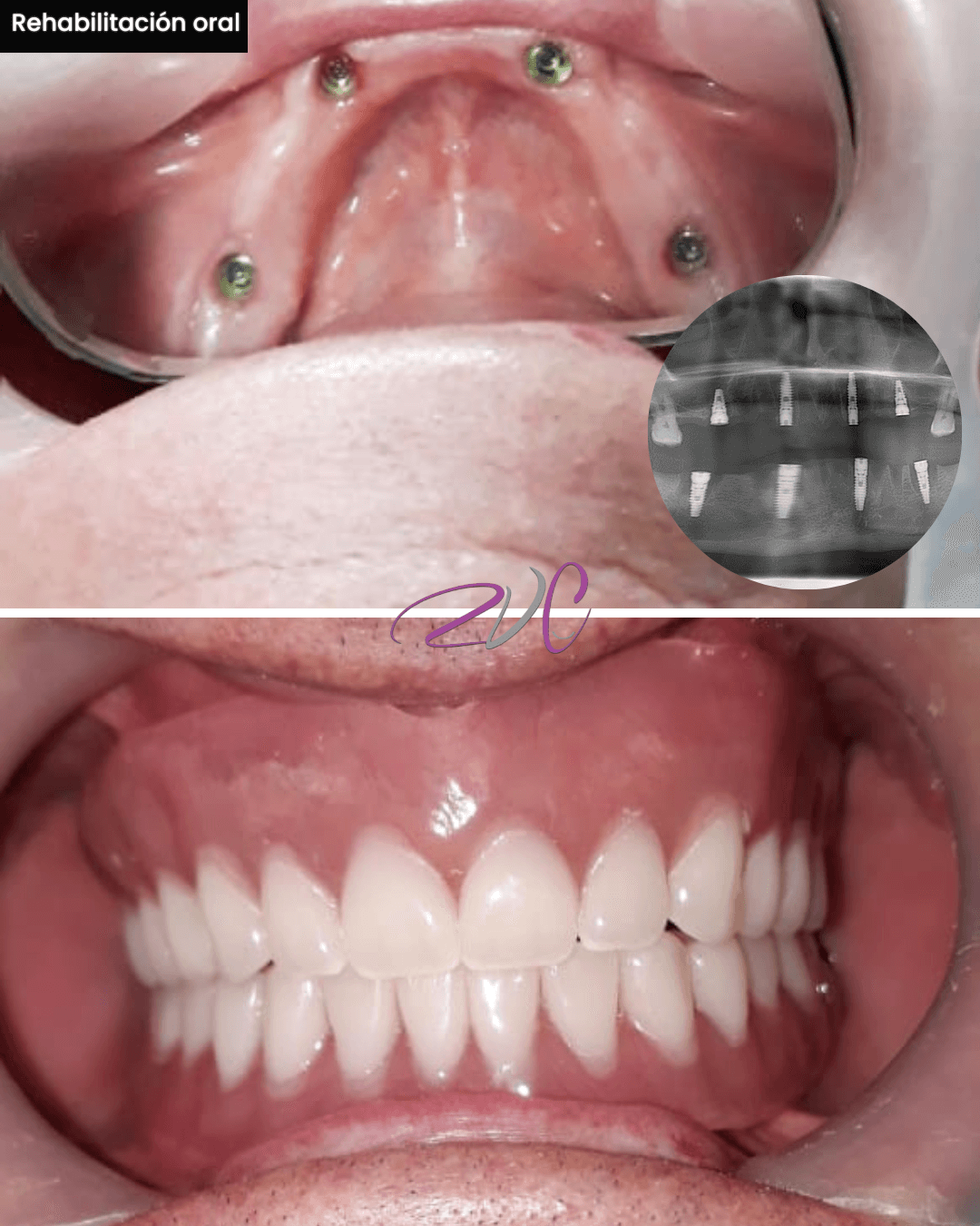 Rehabilitación oral