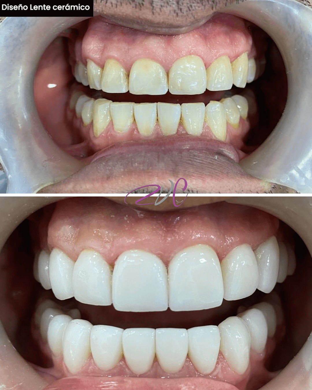 Diseño lente cerámico