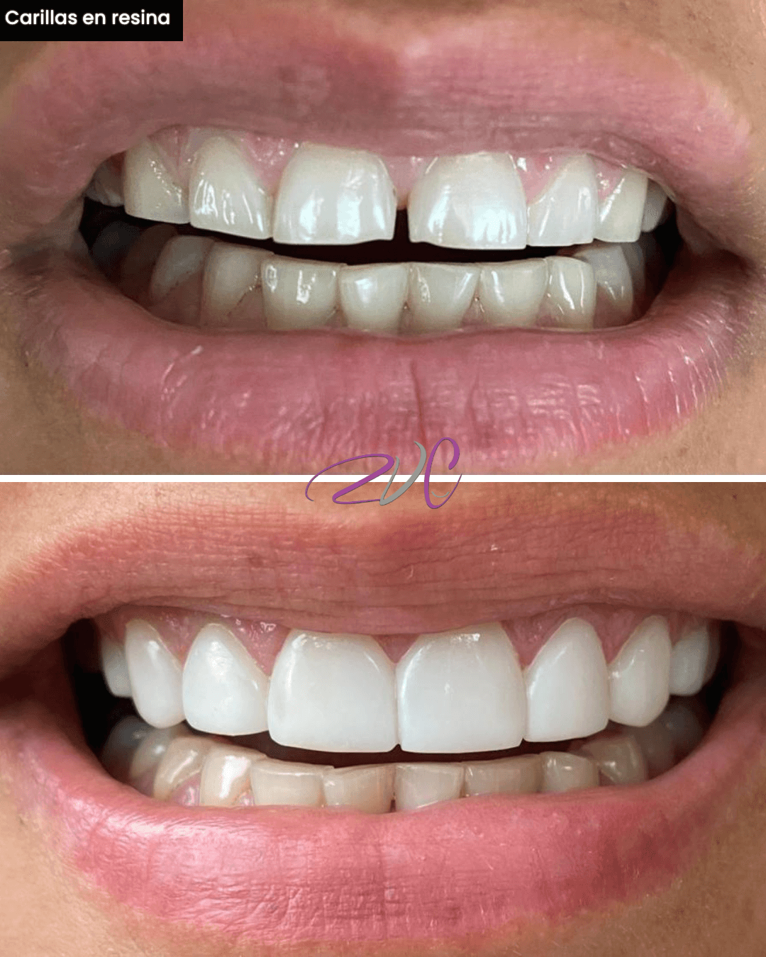 Carillas en resina
