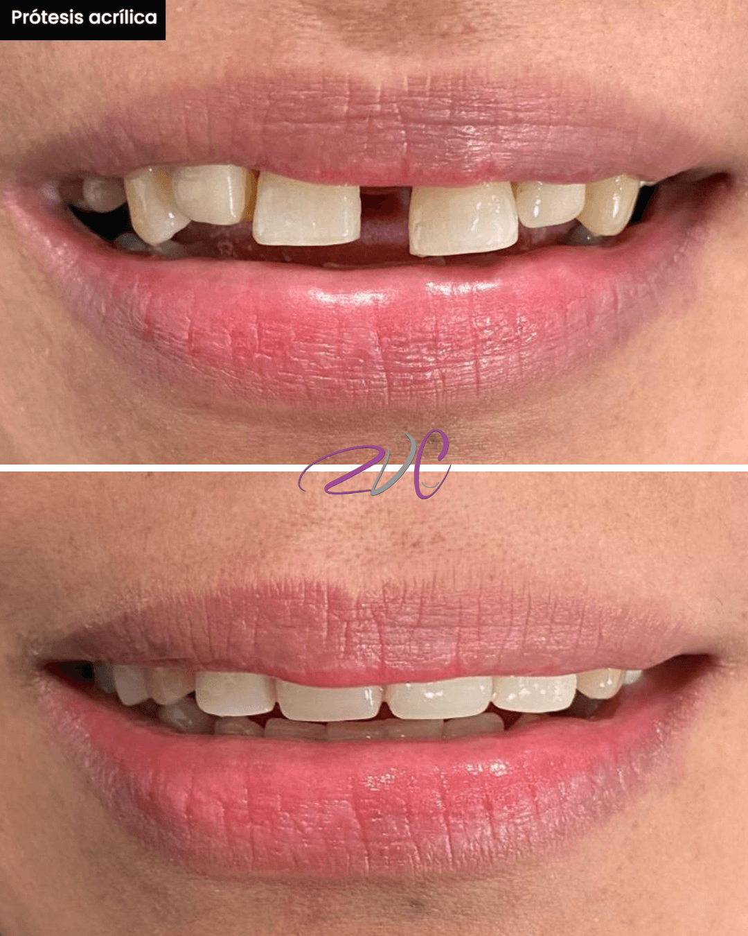 Prótesis acrilica