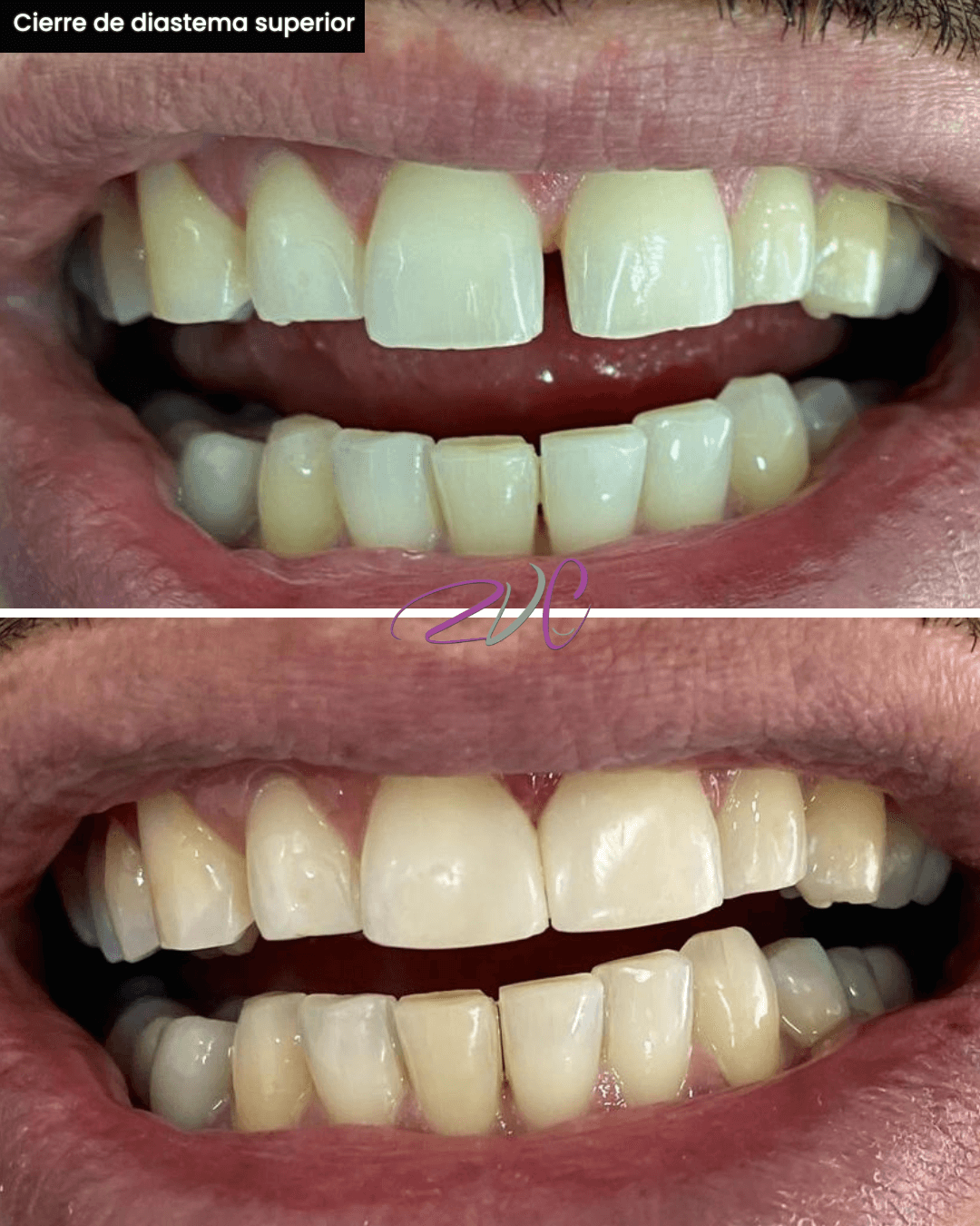 Cierre de diastema superior