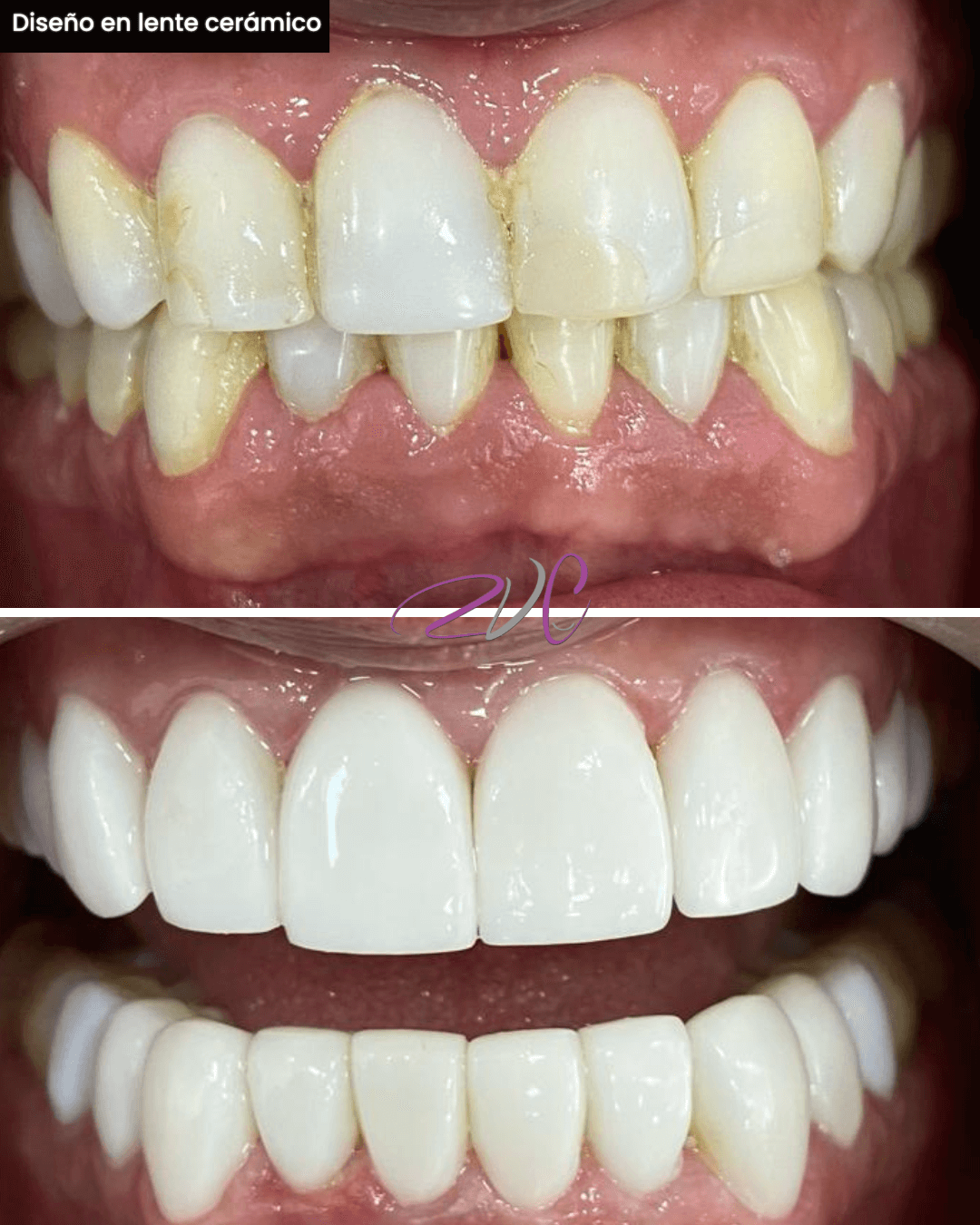 Diseño en lente cerámico