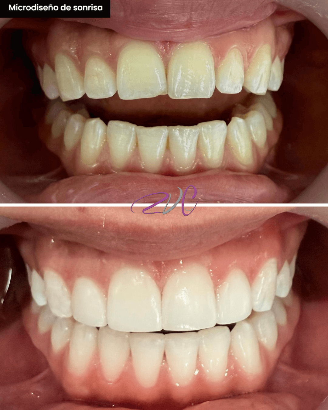 Microdiseño de sonrisa