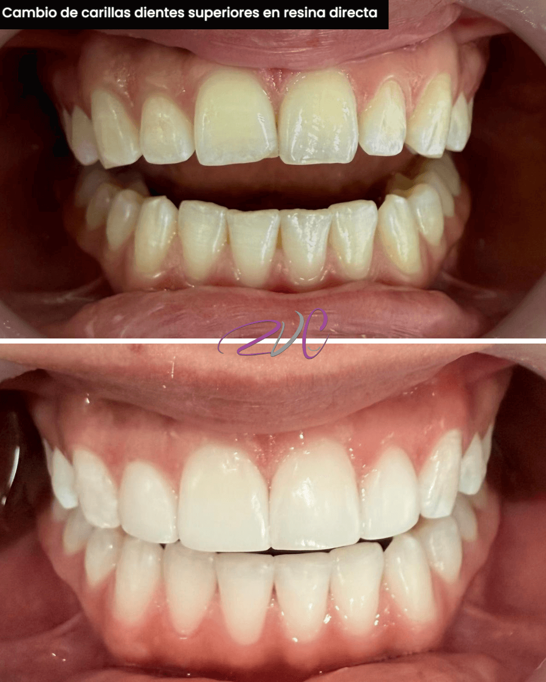 Cambio de carillas dientes superiores en resina directa