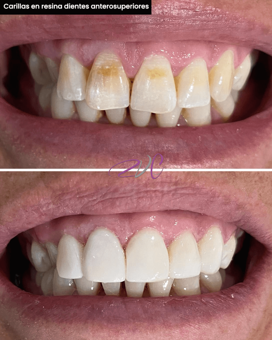 Carillas en resina dientes anterosuperiores
