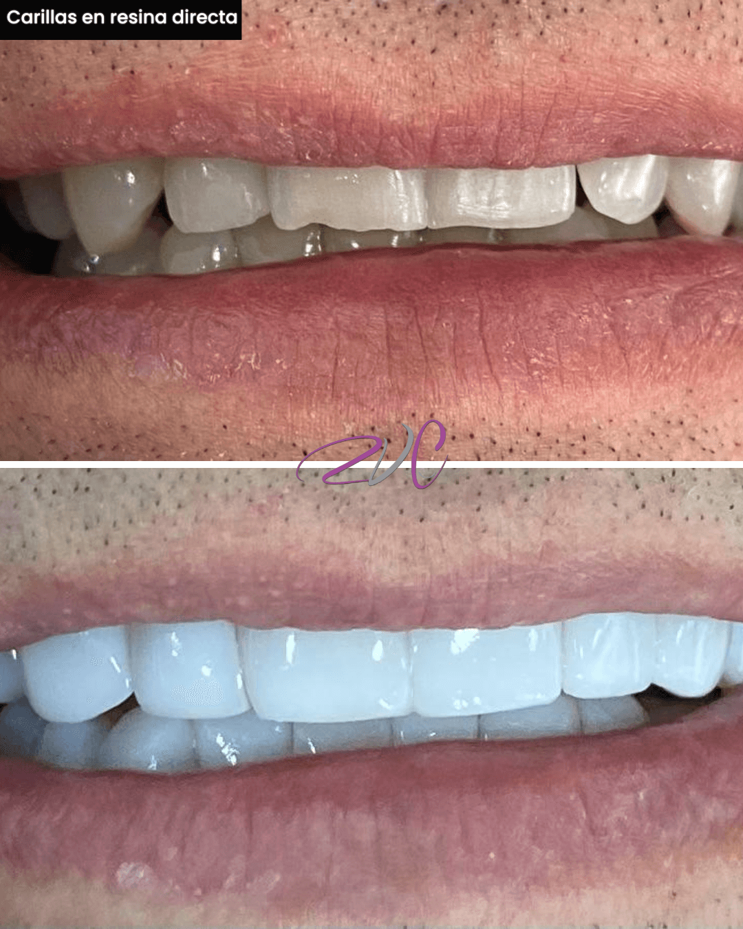 Carillas en resina directa