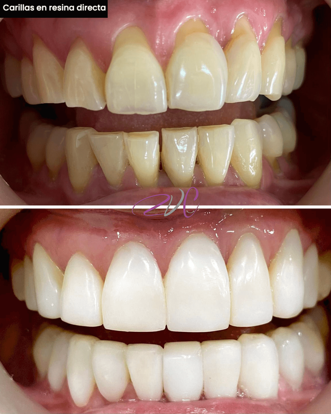 Carillas en resina directa