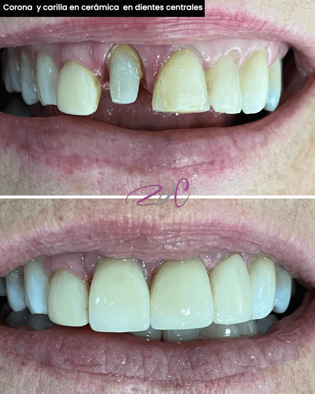 Corona y carilla en cerámica en dientes centrales