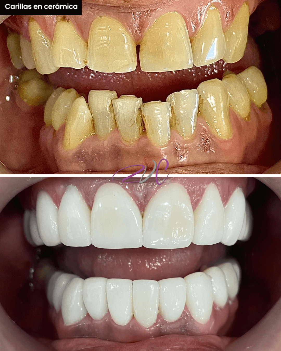 Carillas en cerámica