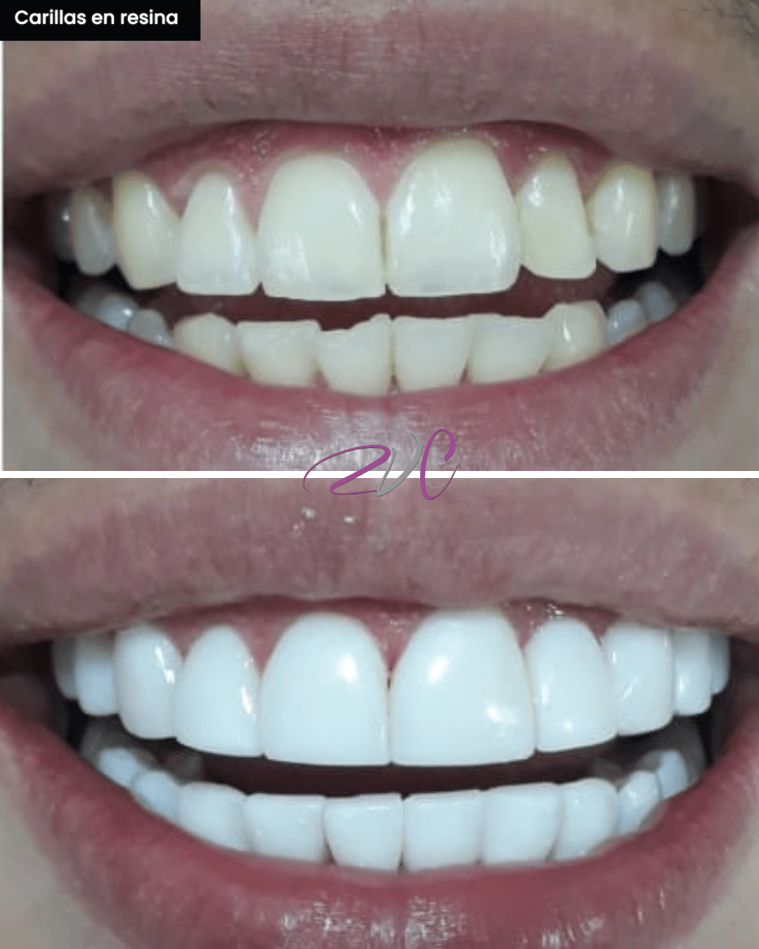 Carillas en resina