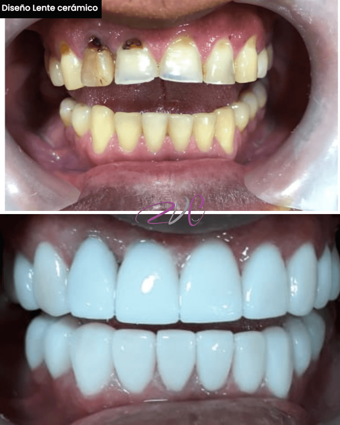 Diseño en lente cerámico