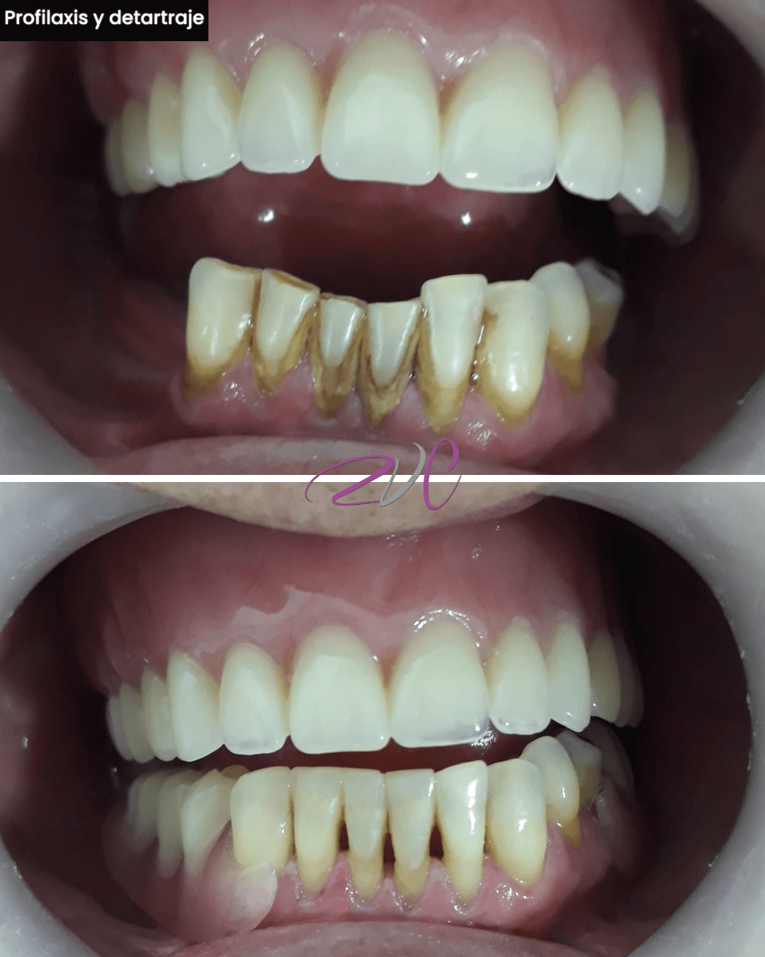 Profilaxis y detartraje